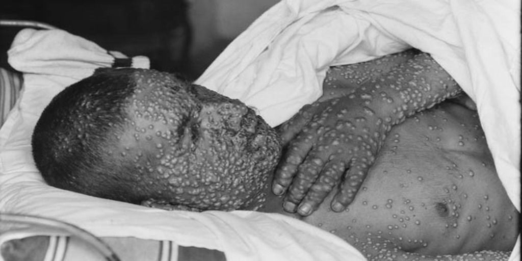 History’s Worst Pandemics